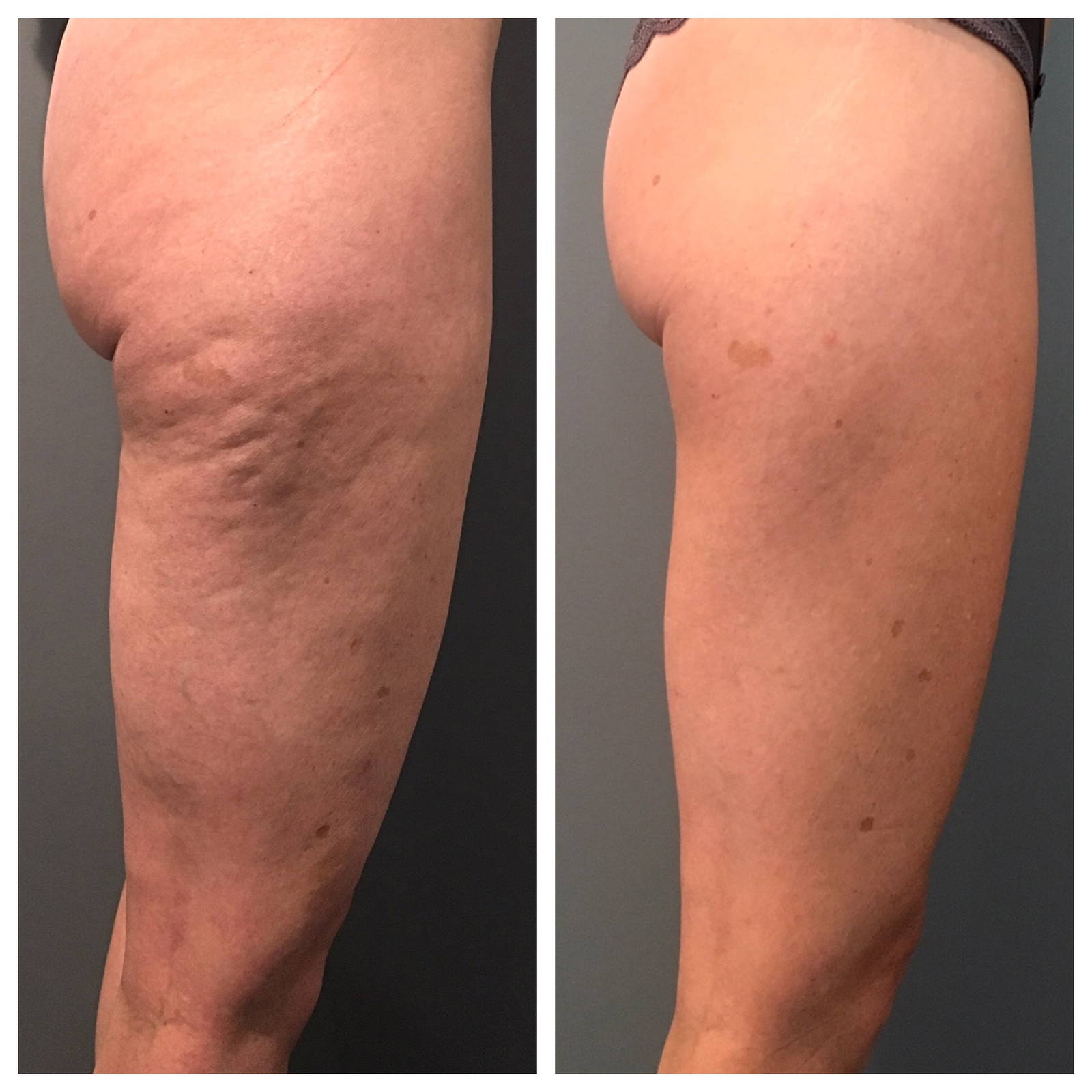 Viora Cellulite Reduction Treatment Reviews